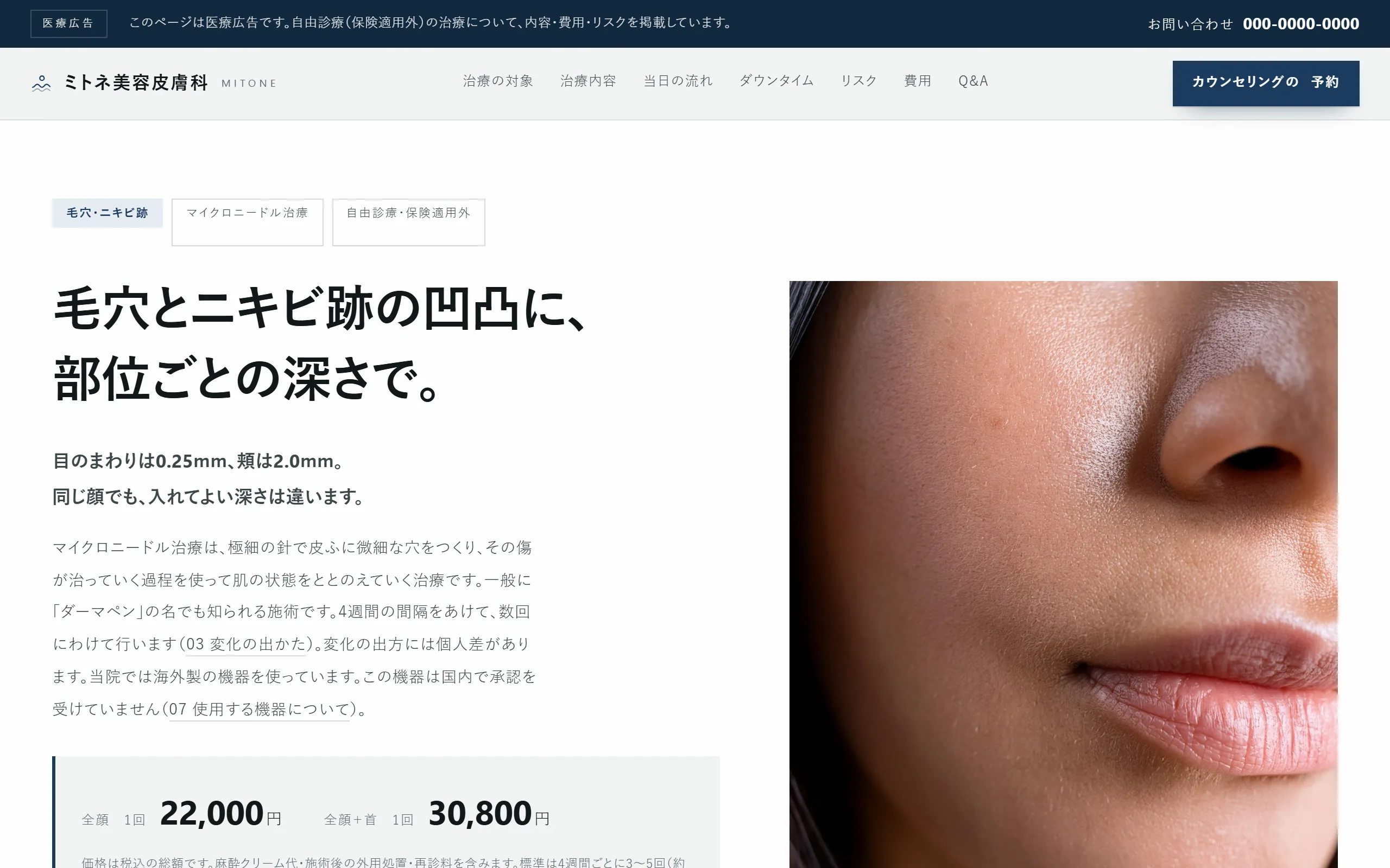 架空の「ミトネ美容皮膚科クリニック」のマイクロニードル治療のページのファーストビュー。見出し「0.25mmきざみで、針の深さを決める。」と、施術室の写真、税込の料金